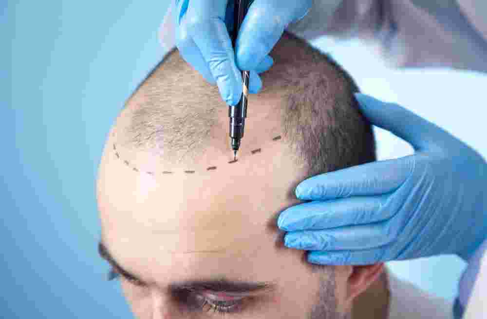 how-fue-hair-transplant-in-delhi-helps-restore-hair-naturally-big-0