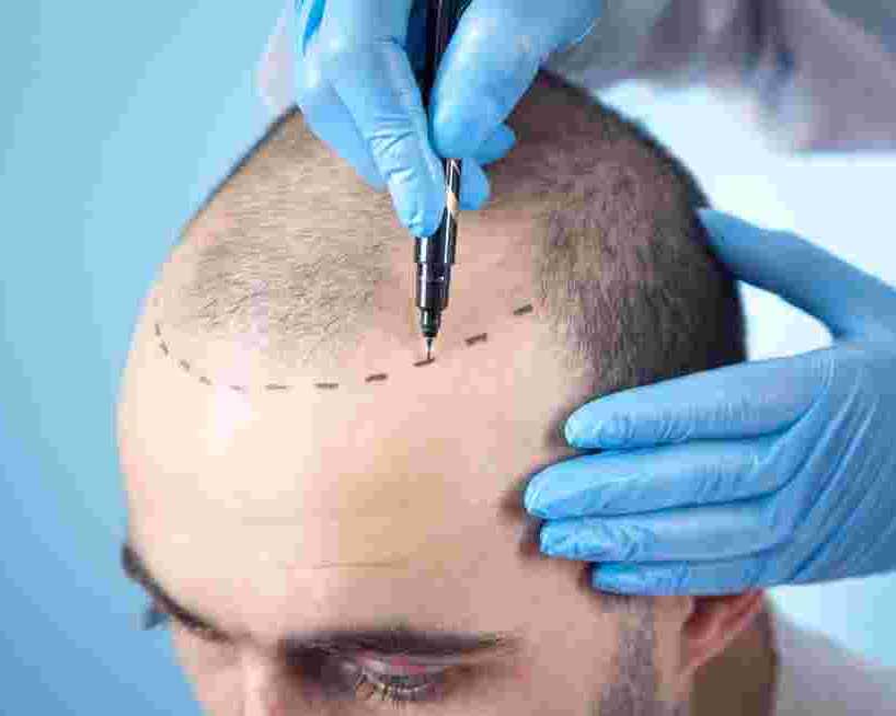 how-fue-hair-transplant-in-delhi-helps-restore-hair-naturally