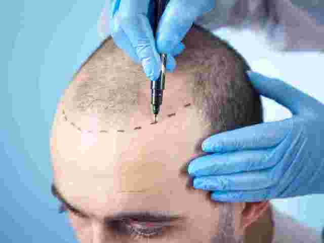 how-fue-hair-transplant-in-delhi-helps-restore-hair-naturally