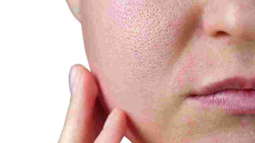 achieve-healthier-skin-with-open-pores-treatment-in-vasant-kunj-big-0