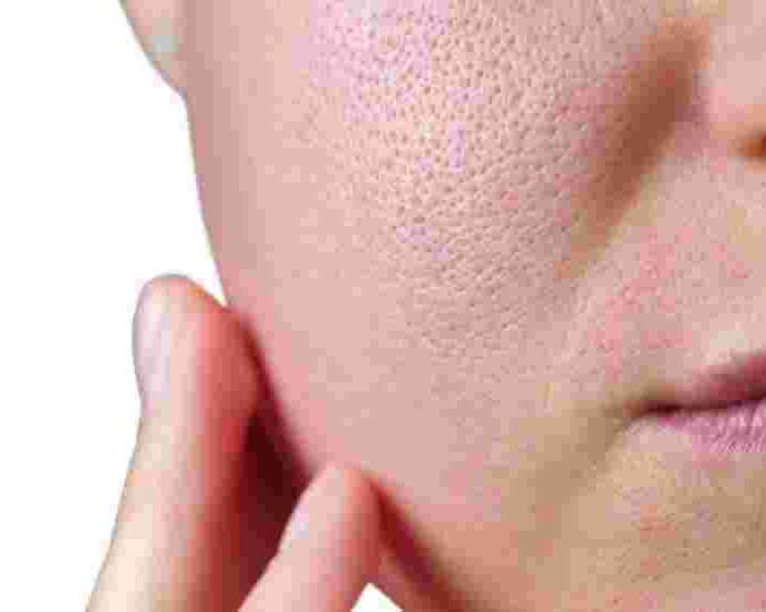 achieve-healthier-skin-with-open-pores-treatment-in-vasant-kunj