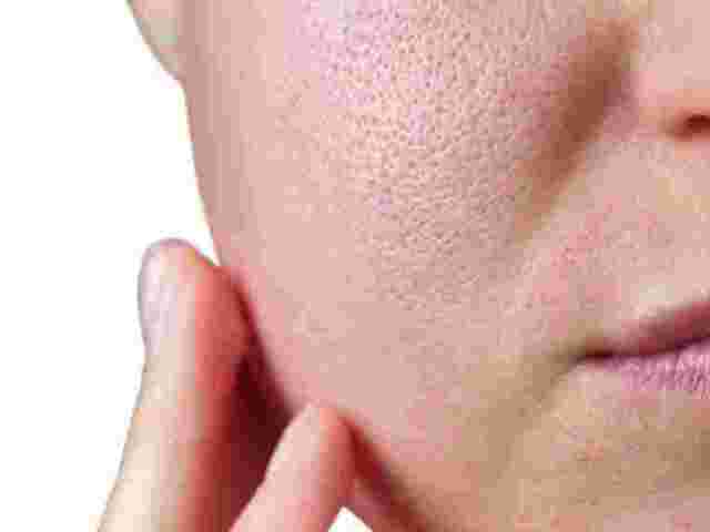 achieve-healthier-skin-with-open-pores-treatment-in-vasant-kunj