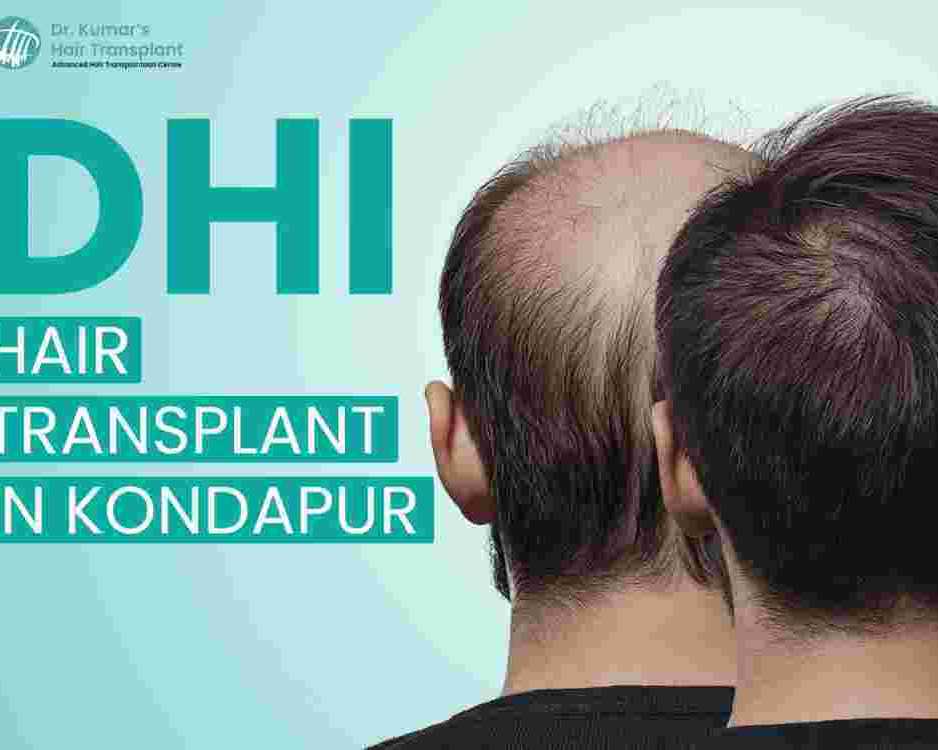 dhi-hair-transplant-you-should-know-before-treatment