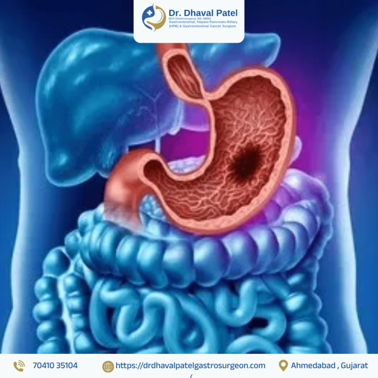 advance-gi-cancer-surgery-with-recovery-and-care-in-ahmedabad-big-0