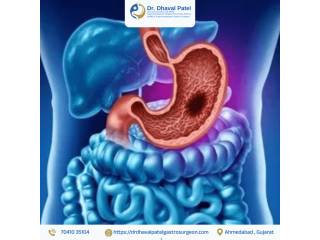 advance-gi-cancer-surgery-with-recovery-and-care-in-ahmedabad-small-0