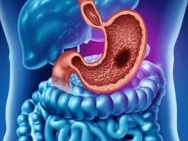 advance-gi-cancer-surgery-with-recovery-and-care-in-ahmedabad