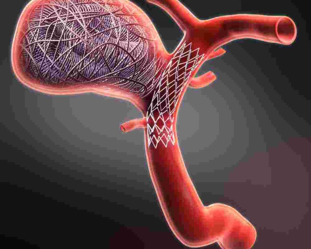 coiling-surgery-minimally-invasive-treatment-for-brain-aneurysms