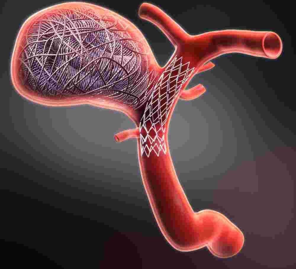 coiling-surgery-minimally-invasive-treatment-for-brain-aneurysms-big-0