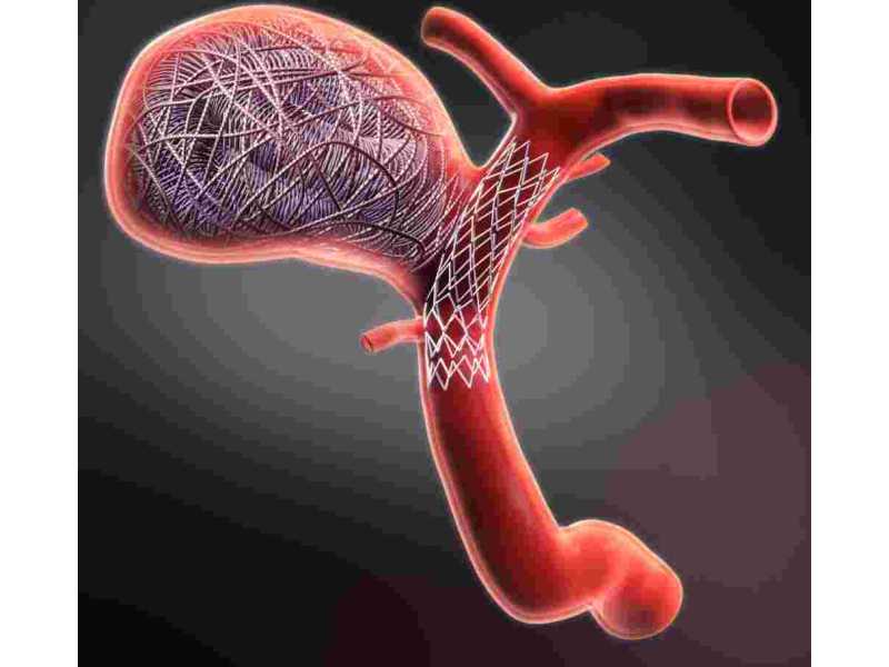 coiling-surgery-minimally-invasive-treatment-for-brain-aneurysms-small-0