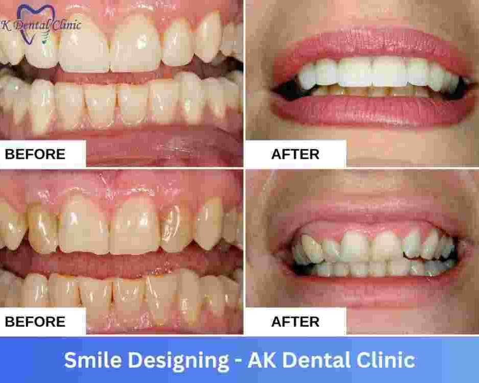 specialized-smile-designing-in-vile-parle-mumbai