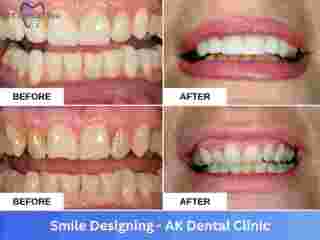 specialized-smile-designing-in-vile-parle-mumbai-small-0