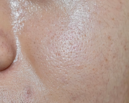 how-to-control-oily-skin