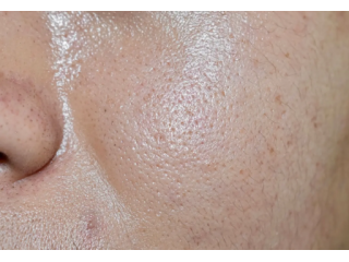 how-to-control-oily-skin-small-0