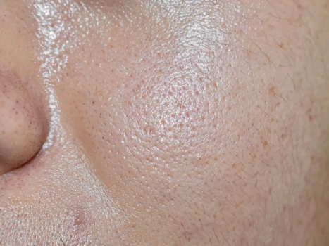how-to-control-oily-skin