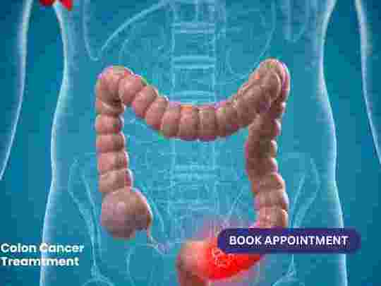 get-the-best-colon-cancer-treatment-in-ahmedabad-for-faster-healing