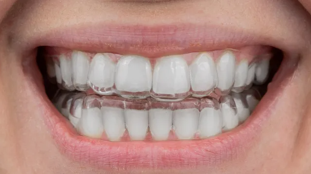 clear-teeth-aligners-treatment-the-dental-wellness-centre-big-0