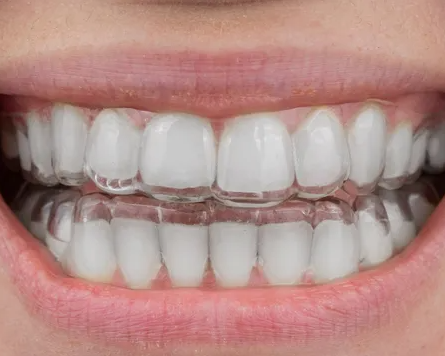clear-teeth-aligners-treatment-the-dental-wellness-centre