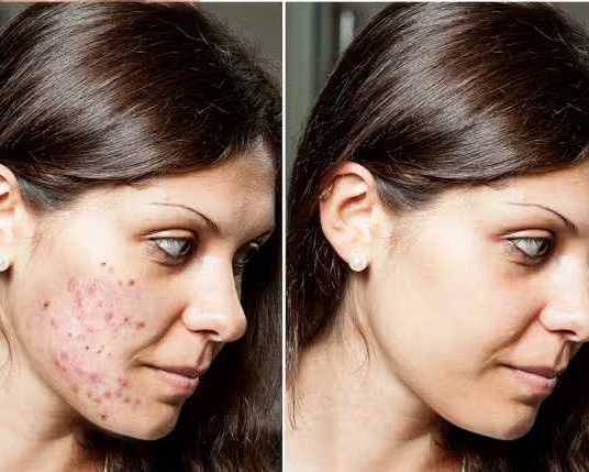 reasons-for-acne-on-cheeks-how-to-get-rid-of-cheek-acne