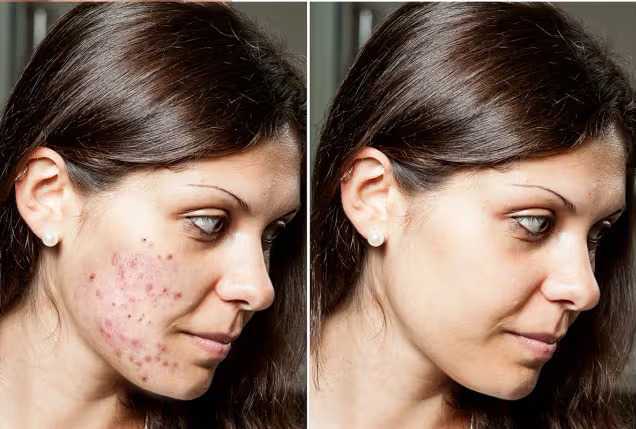 reasons-for-acne-on-cheeks-how-to-get-rid-of-cheek-acne-big-0