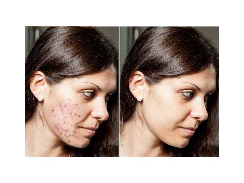 reasons-for-acne-on-cheeks-how-to-get-rid-of-cheek-acne-small-0