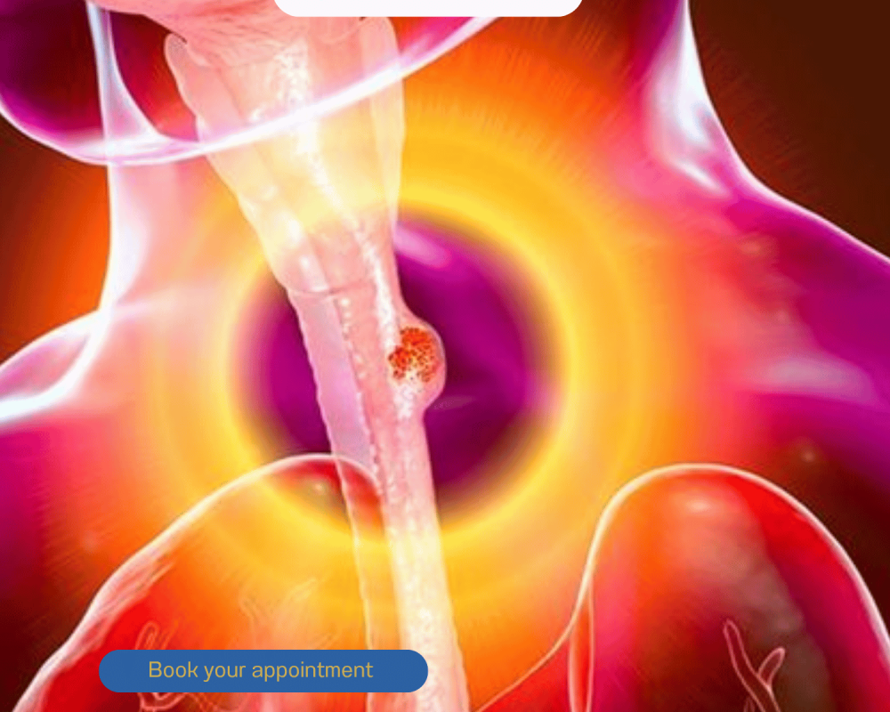 expert-food-pipe-cancer-treatment-by-dr-dhaval-patel-in-ahmedabad