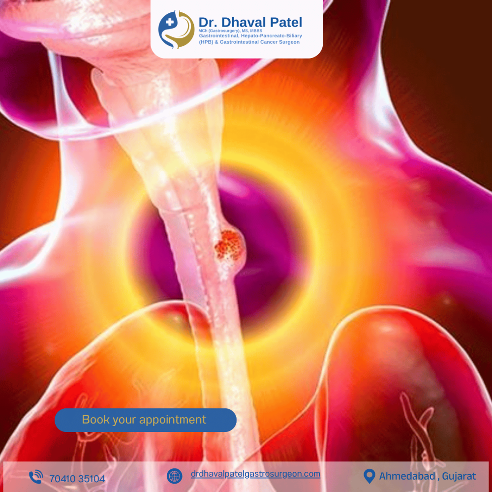 expert-food-pipe-cancer-treatment-by-dr-dhaval-patel-in-ahmedabad-big-0