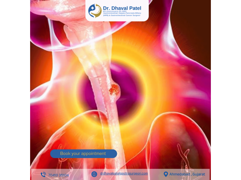 expert-food-pipe-cancer-treatment-by-dr-dhaval-patel-in-ahmedabad-small-0