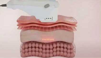 hifu-treatment-in-gurgaon-for-skin-lifting-big-0
