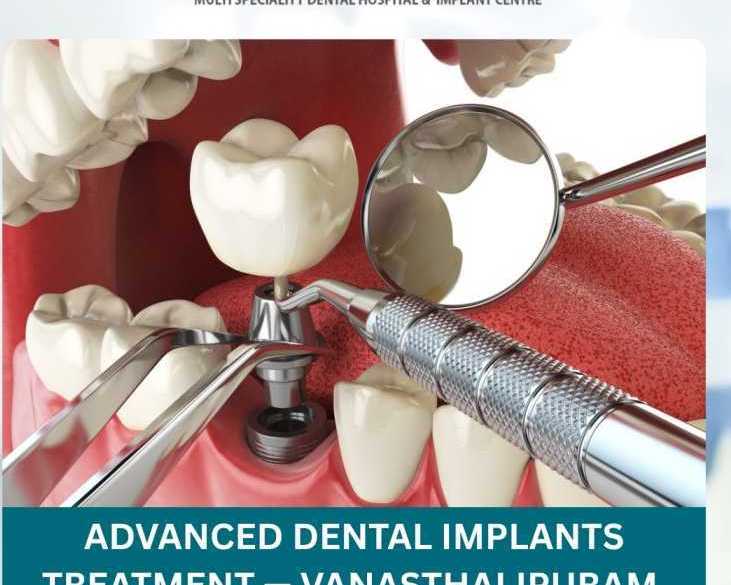 advanced-dental-implants-treatment-vanasthalipuram-clinic