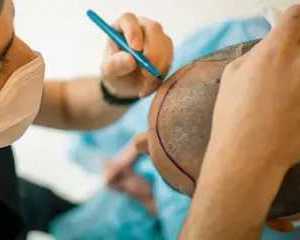 y-cell-prp-treatment-for-hair-loss-acne-scars-pigmentation