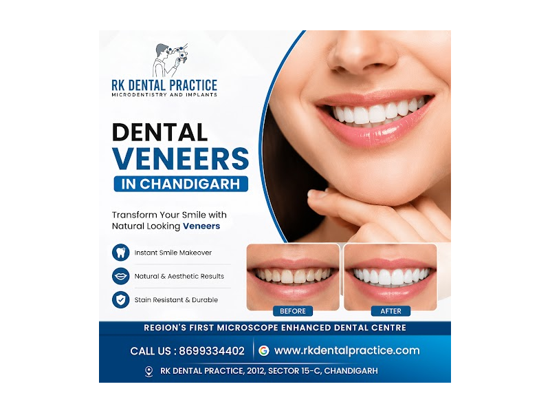 dental-veneers-in-chandigarh-for-cosmetic-smile-enhancement-small-0
