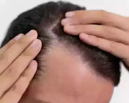 healthier-hair-with-gfc-therapy-in-greater-noida-west-dermalinks-clinic