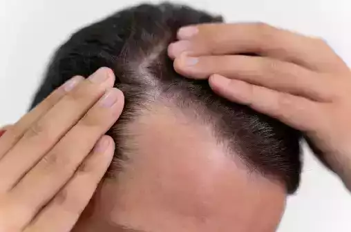 healthier-hair-with-gfc-therapy-in-greater-noida-west-dermalinks-clinic-big-0