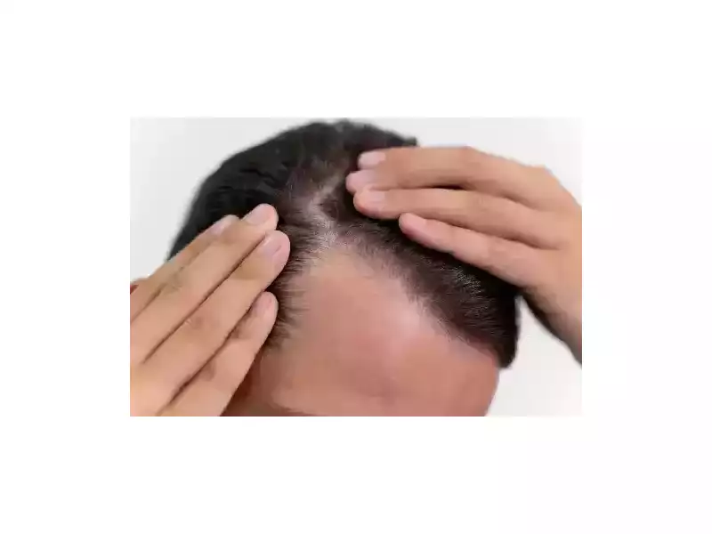 healthier-hair-with-gfc-therapy-in-greater-noida-west-dermalinks-clinic-small-0