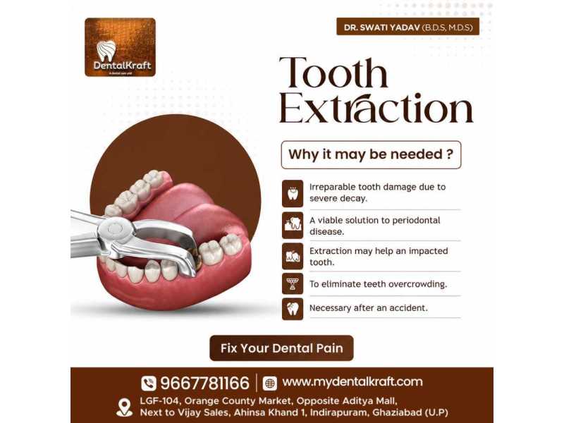 best-dentist-for-tooth-extraction-in-indirapuram-for-safe-small-0