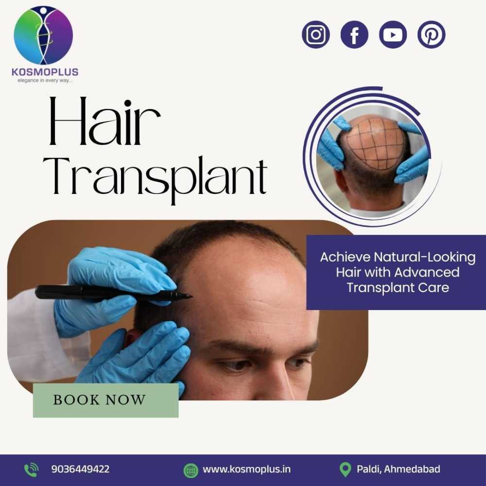 say-goodbye-to-bald-patches-with-hair-transplant-in-ahmedabad-big-0