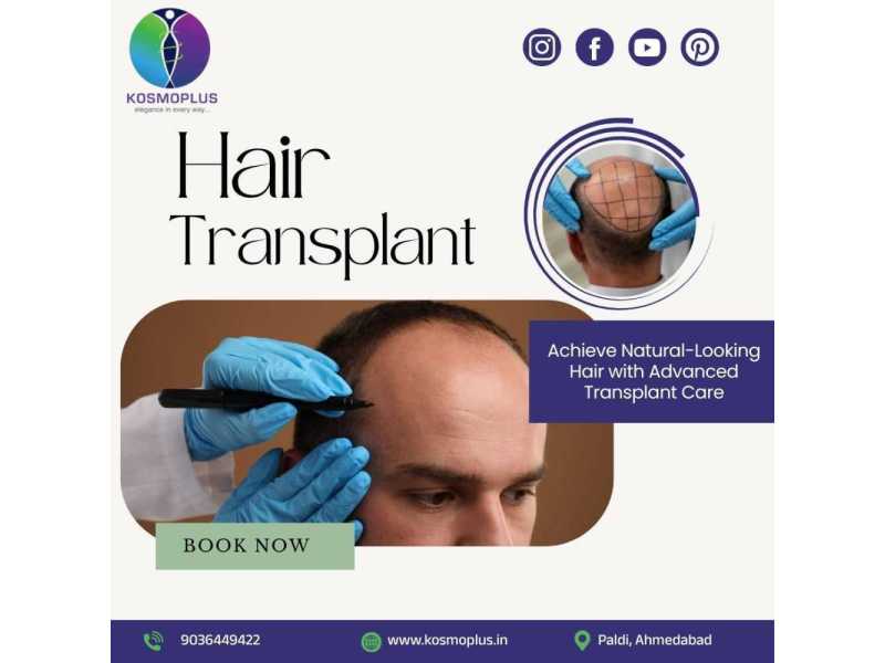 say-goodbye-to-bald-patches-with-hair-transplant-in-ahmedabad-small-0