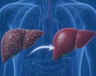 hire-liver-replacement-surgery-india-experts-at-medtreeva