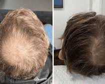what-are-the-benefits-of-regenerative-hair-care-treatments
