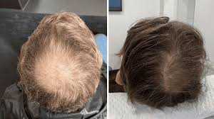 what-are-the-benefits-of-regenerative-hair-care-treatments-big-0