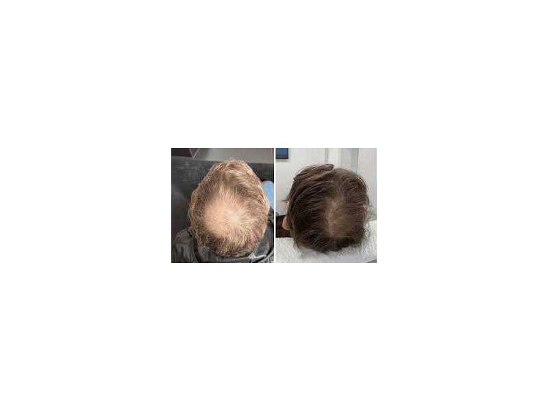 what-are-the-benefits-of-regenerative-hair-care-treatments-small-0