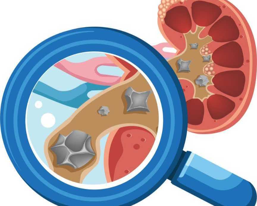 advanced-rirs-treatment-in-nagli-safe-effective-kidney-stone-removal