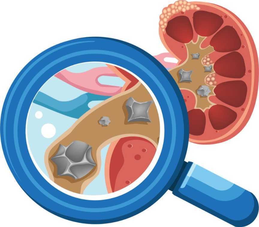 advanced-rirs-treatment-in-nagli-safe-effective-kidney-stone-removal-big-0