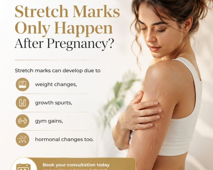 stretch-marks-arent-just-a-pregnancy-concern