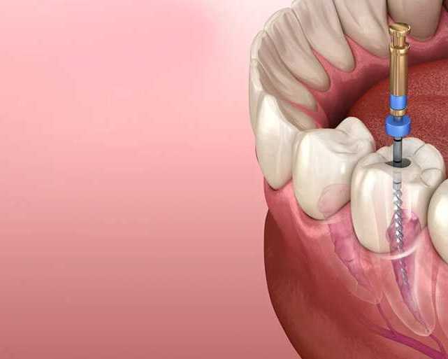advanced-root-canal-treatment-in-thane