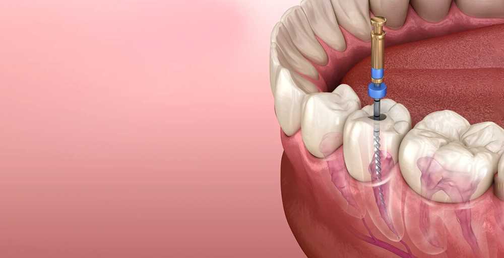 advanced-root-canal-treatment-in-thane-big-0