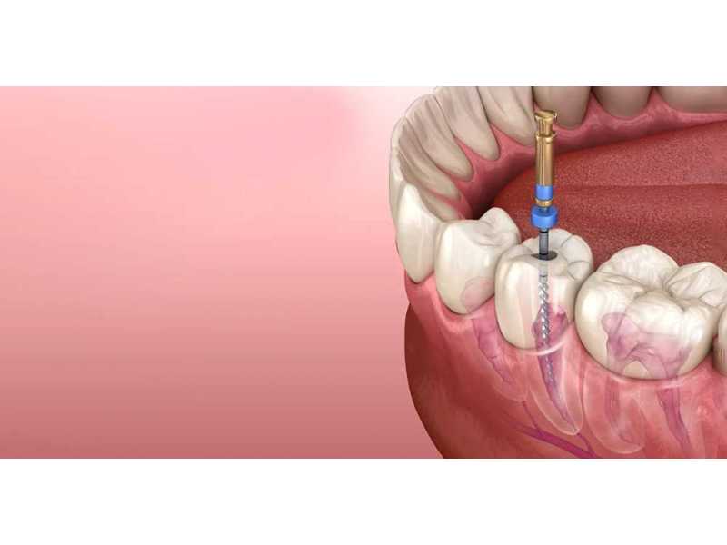 advanced-root-canal-treatment-in-thane-small-0