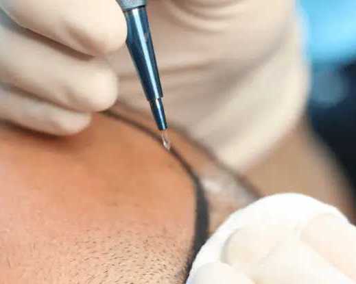 best-sapphire-fue-hair-transplant-clinic-in-coimbatore