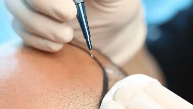best-sapphire-fue-hair-transplant-clinic-in-coimbatore-big-0