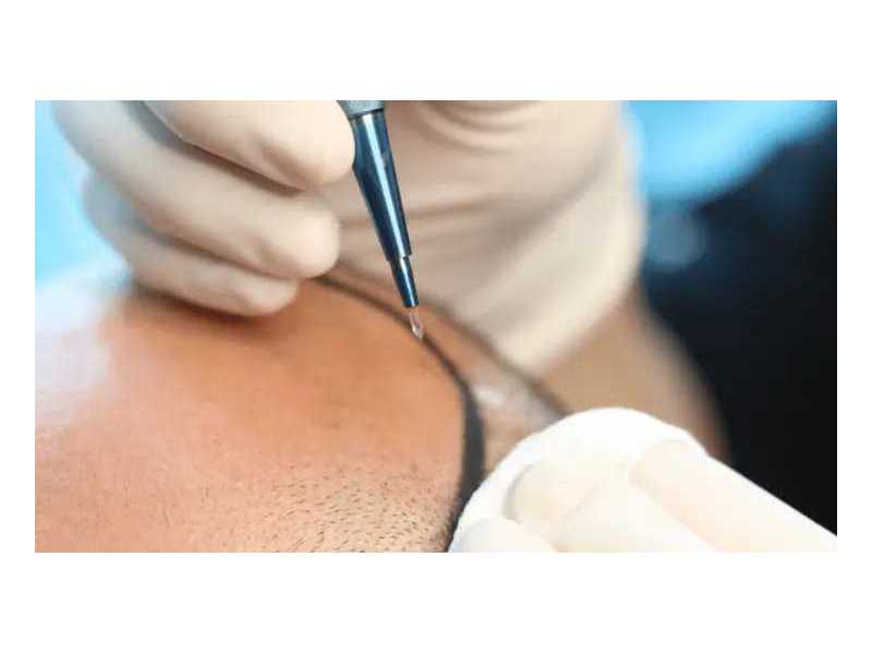 best-sapphire-fue-hair-transplant-clinic-in-coimbatore-small-0